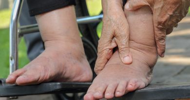 edema